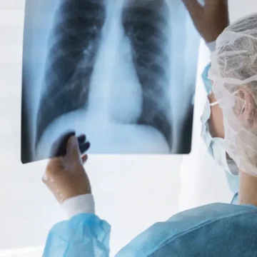 Diagnóstico tardio deixa quase metade dos pacientes com câncer de Diagnóstico tardio deixa quase metade dos pacientes com câncer de pulmão sem tratamento