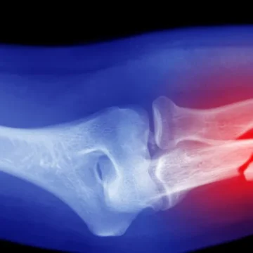 RED-S: a síndrome silenciosa que enfraquece os ossos até dos atletas mais saudáveis
