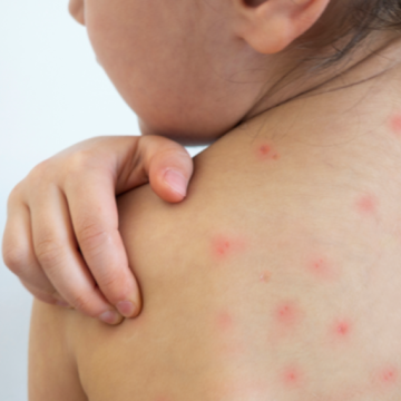 Sarampo: o que acontece quando uma geração começa a esquecer o valor da vacina