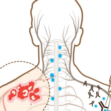 Vacina do herpes-zóster vai chegar ao SUS? Entenda Projeto de Lei