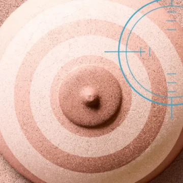 Cirurgia ou quimioterapia? O que vem primeiro contra o câncer de mama