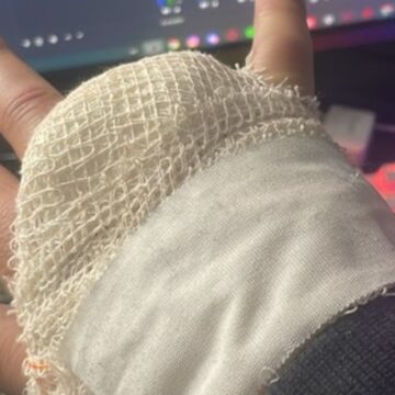 Streamer Lodk perde dedo no Rock in Rio e diz Streamer Lodk perde dedo no Rock in Rio e diz se arrepender