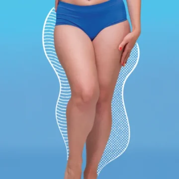 Celulite ou lipedema? Como diferenciar antes de se autodiagnosticar