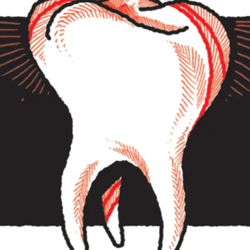 Após perda de dente, enxerto ósseo devolve capacidade de comer e sorrir